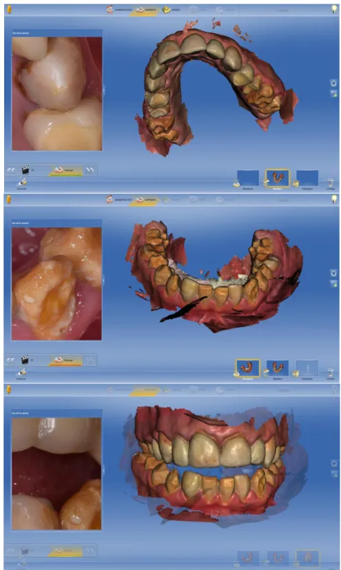 Figure 9 : Empreintes d'étude pour l’obtention du maitre modèle virtuel: maxillaire, mandibulaire et  balayage vestibulaire pour RIM