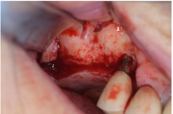 Figure 5 : Décollement muco-périostée après incision crestale et décharge vestibulaire mésiale 