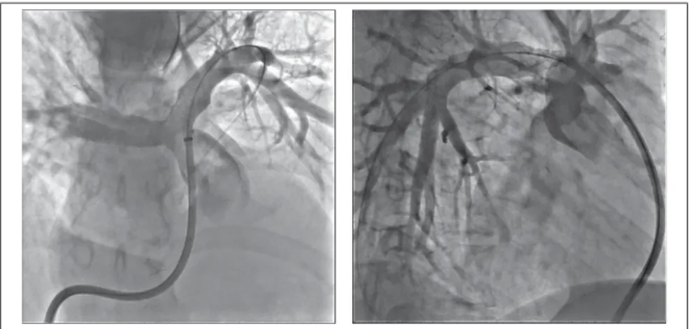 Figure 1.3 Angiographique biplan des artères pulmonaires