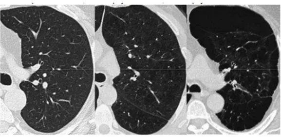 Figure 5 : TDM thoracique avec de gauche à droite : hémichamp pulmonaire gauche au  niveau de la carène d'un poumon normal, d'un emphysème diffus, d'un emphysème bulleux 