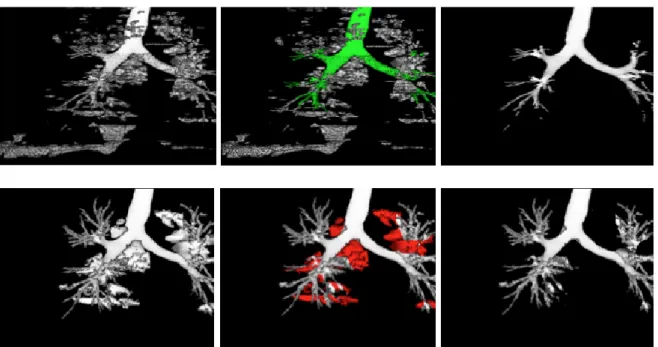 Figure  9  :  Segmentation  bronchique  en  mode  semi-automatique.  De  gauche  à  droite  : candidats  bronchiques  en  phase  d'initialisation  ;  sélection  des  structures  à  conserver  ;  candidats  bronchiques  finaux  ;  propagation  des  candidat