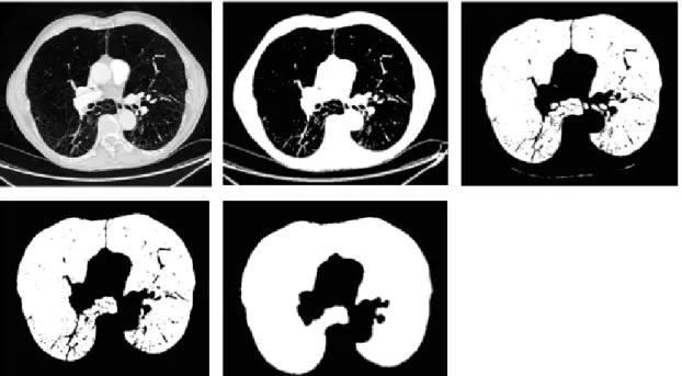 Figure 12 : Méthode d'extraction des poumons. De gauche à droite : image originale ; binarisation ; extraction des  poumons  ;  ouverture  (ici  taille  1)  et  conservation  des  deux  composantes  connexes  les  plus  grandes  ;  fermeture  pour régulari