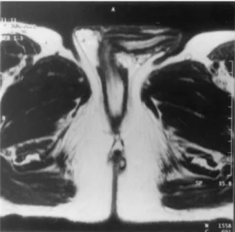 Figure  12  Image  IRM  (séquence  T2)  d’une  fistule  simple  intersphinctérienne.  Les  lésions  inflammatoires apparaissent hyperintenses (blanc) et le trajet fistuleux hypointense (noir) [61]