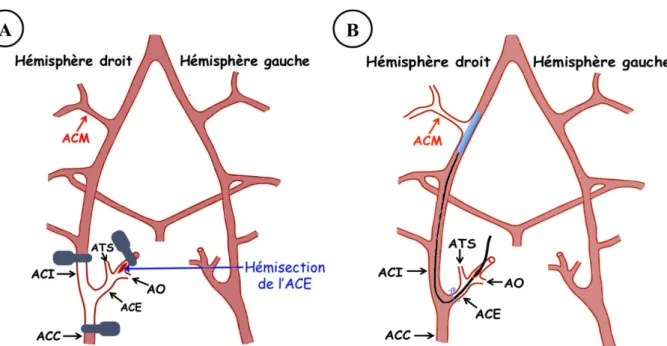 Figure 1.15 : Étapes majeures de la méthode MCAo-r. A) L’ACC, l’ACE et l’ACI du côté droit sont clampées