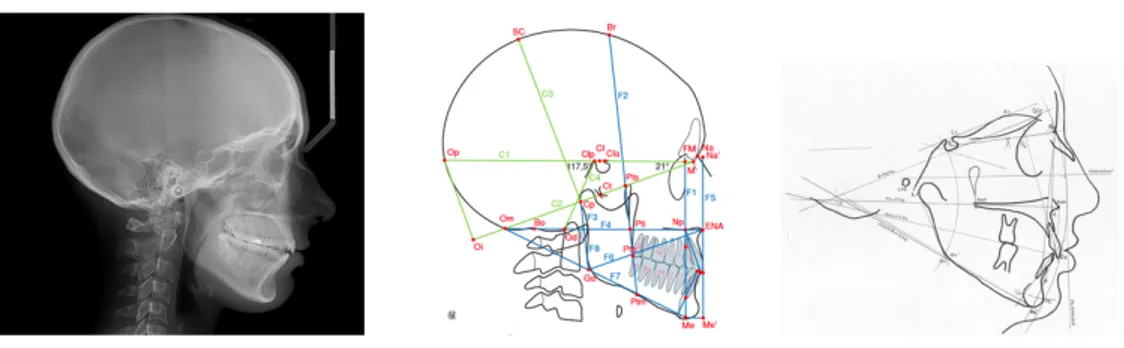 Figure 24 : A gauche, téléradiographie de profil. Au centre, analyse céphalométrique de Delaire [17], à droite,  analyse céphalométrique de Sassouni (www.unige.ch)