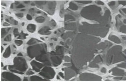 Figure 1 : Tissu osseux d'une personne saine (gauche) et d'une personne touchée  par l'ostéoporose (droite), caractérisée par une faible densité osseuse et des défauts  architecturaux