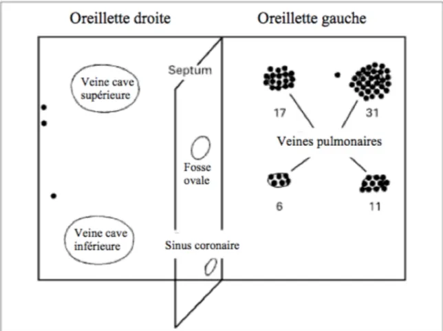 Figure 13 : Schéma représentant les localisations anatomiques de 69 foyers ectopiques chez  45 patients en FA paroxystique