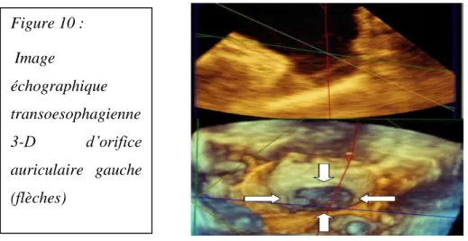 Figure 10 :   Image  échographique  transoesophagienne  3-D  d’orifice  auriculaire  gauche  (flèches)  Figure 11 :   Représentation  schématique en ETO du  col  (bleu)  et  du  corps  (rouge)  de  l’auricule  gauche 