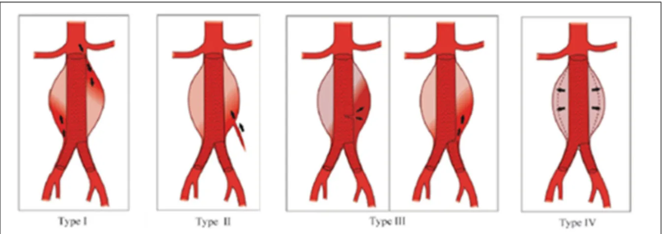 Figure 1.7 Various types of endoleak: type I, leak at the attachment site; 