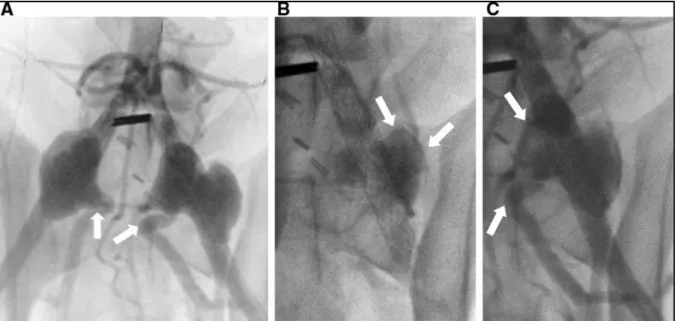 Figure 3.6 A Angiography of the bilateral aneurysm model, showing the bilobal form of  the left aneurysm (Dog #4) (white arrows = outflow through the reimplanted caudal  artery); B fluoroscopic image of the left aneurysm, showing incomplete embolization by