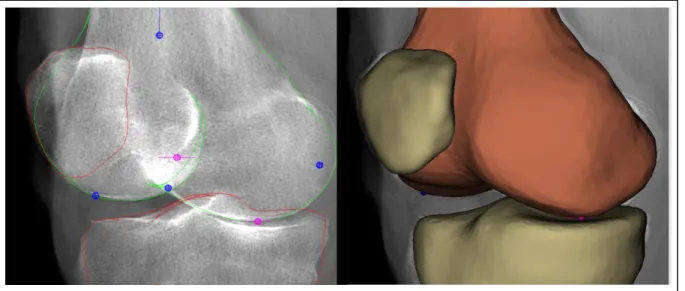 Figure 1-9 Reconstruction of the bone using EOS® biplane X-ray images. 