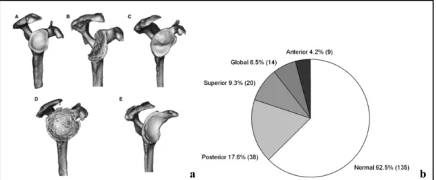 Figure 2.5 Illustration des différents types d’usure de glène après reconstruction par scanner et  la proportion des cas dans une étude de 216 glènes