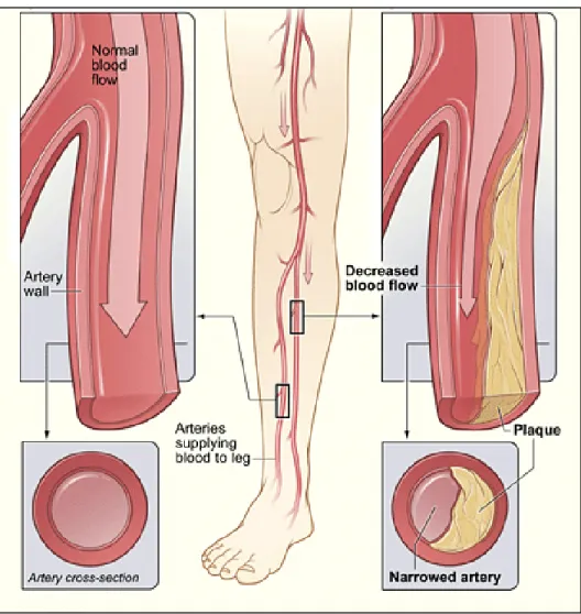 Figure 1.1 Comparison between healthy artery (left) and narrowed  artery in PAD (right) 