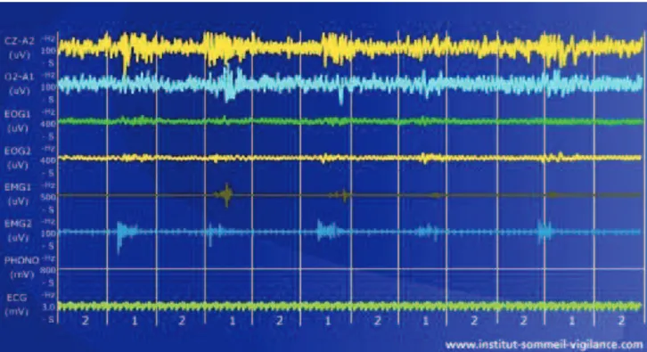Figure 6 - Extrait d’enregistrement polygraphique du sommeil d’une durée de 2 min montrant  une activité électromyographique des muscles fléchisseurs du pied droit (EMG1) et gauche  (EMG2) répétée toutes les 10 à 20 sec entraînant un éveil visible à l’EEG 