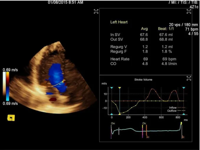 Figure 5 : évaluation des débits aortique et mitrale par technique de débit couleur 3D eSie flow