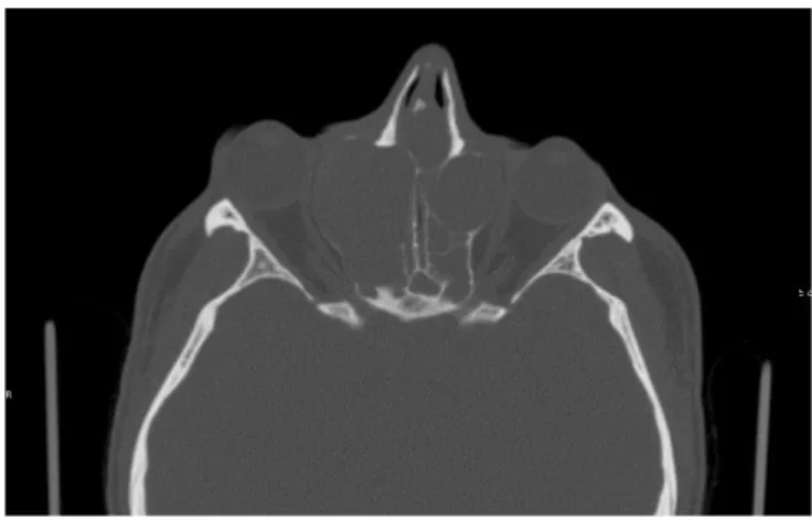 Figure 1 - TDM des sinus en coupe axiale. Mucocèle bilatérale ethmoïdale. Source : service de  Neuroradiologie, Hôpital Lariboisière