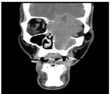 Figure 2 - TDM des sinus en coupe coronale. Lyse orbito-fronto-maxillaire gauche, observée dans un  carcinome épidermoïde