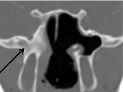 Figure 3 – TDM des sinus en coupe coronale.  Infiltration du corps du sphénoïde droit (flèche noire)  par un fibrome nasopharyngé