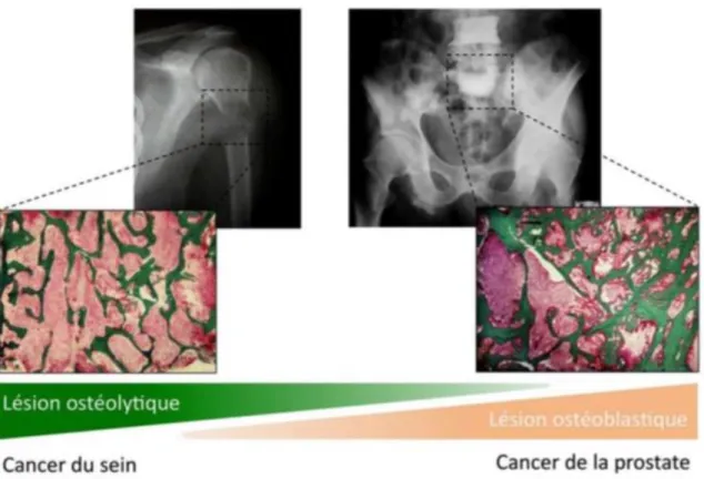 Figure 9 - Les métastases osseuses sont soit ostéolytiques (os aminci) soit ostéocondensantes (travées  osseuses minéralisées) soit mixtes