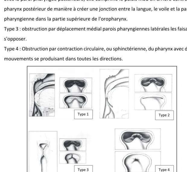 Figure 4 : Mécanismes d’obstruction des voies aériennes chez les enfants porteurs de malformations  cranio-faciales