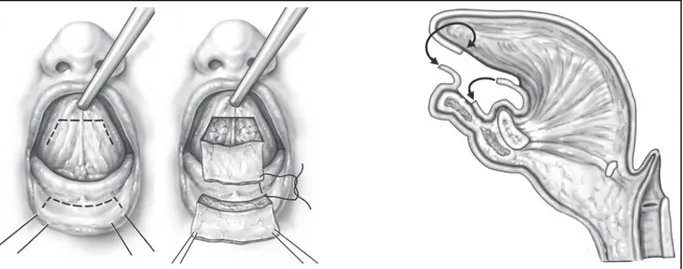 Figure 7 :Schéma de Labioglossopexie non transfixiante sans boutons telle que réalisée dans le centre à Marseille  D’après Qaqish et Caccamese – 2009 – The tongue-lip adhesion (30) 