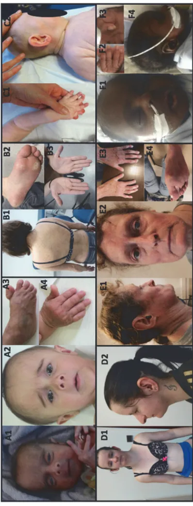Figure 4. Pictures of patients P1, P2, P5, P10, P11, P13. A1-A4: Patient P1, on A1 ten days after birth and on A2-A4 at the age of 11 months,  affected with De Barsy syndrome (PYCR1: c.616G&gt;A at homozygous state); B1-B3 : Patient P2 affected with Rothmu