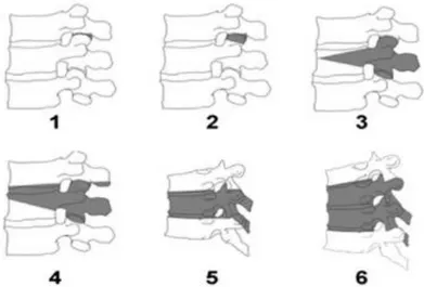 Figure 2.12 : Osteotomy classification grades 1 to 6 (Image reused with permission of: F