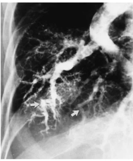 Figure   4   :   Angiographie   pulmonaire   droite   montrant   des   vaisseaux   pulmonaires   dilatés   et   tortueux    chez   une   patiente   de   68   ans   avec   un   SHP