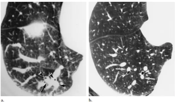 Figure   5   :   Scanner   thoracique   coupes   fines   du   lobe   inférieur   droit      