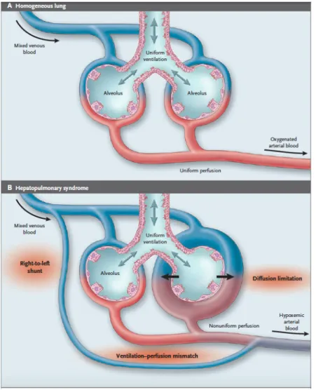 Figure   10   :   Mécanismes   de   l’hypoxémie   artérielle   dans   le   SHP.   D’après   Rodriguez   -­‐Roisin   R.,   Krowka    M.,   N   Engl   J   Med   2008   (42)   
