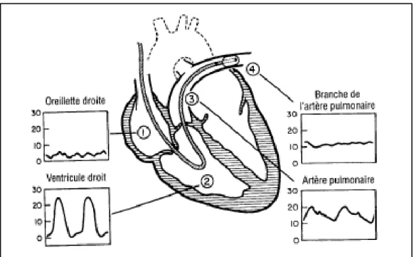 Figure 2: Principe de la thermodilution pulmonaire avec cathéter de Swan-Ganz 