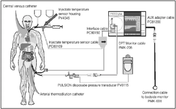 Figure 3: Exemple de système de thermodilution transpulmonaire, le système PiCCO  