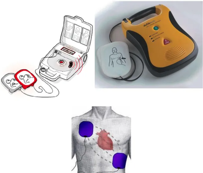 Fig.  1-2-3.  Représentation  d’un  DAE  et  de  son  positionnement  correct  sur  le  thorax 