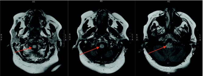 Figure 8a : IRM cérébrale séquence FLAIR, coupe axiale, illustrant l’atteinte bulbaire