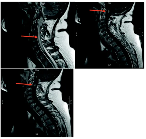 Figure 8b : IRM médullaire séquence T1 avec injection de gadolinium et séquence T2,  illustrant l’aspect de grosse moelle de la myélite transverse étendue avec prise de contraste après  injection de gadolinium