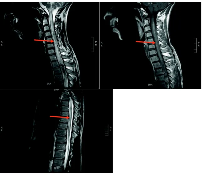 Figure 9a: IRM médullaire T1 avec gadolinium et T2 illustrant la myélite transverse  étendue 