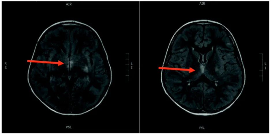 Figure 10a: IRM cérébrale séquence FLAIR illustrant l’atteinte périépendymaire  