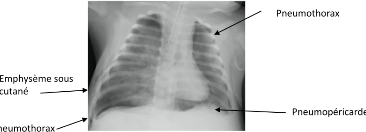 Figure 9 :  Radiographie thoracique de face chez un nourrisson de 2 mois : Pneumopéricarde  et pneumothorax bilatéral