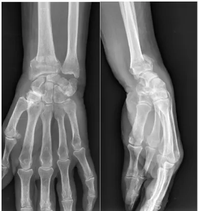 Figure 2 : Bilan radiologique d’une fracture extra-articulaire à bascule postérieure  de  l’extrémité distale du radius chez une patiente de 69 ans  