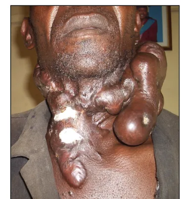 Figure 2. Chéloïde humaine s’étant développée suite à une  blessure  cutanée  située  au  niveau  du  cou