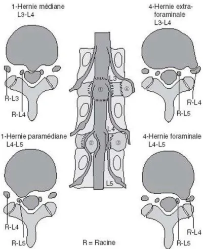 Figure  1.  Localisations  possibles  des  hernies  discales  lombaires  et  contraintes  radiculaires  correspondantes