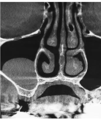 Figure 9 : Kyste mucoïde du sinus maxillaire 