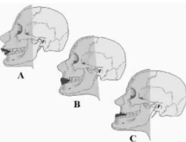 Figure 11 : Représentation des deux grands groupes de dysmorphoses dento-faciales induites par les  troubles neuro-musculaires des personnes handicapées 
