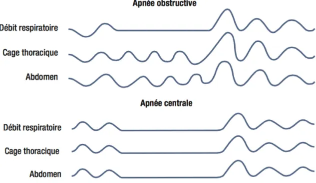 Fig. : 1.3. Différences entre apnées obstructive et centrale. 