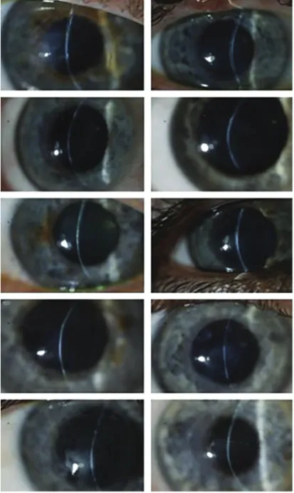 Figure 1: Slit Lamp Biomicroscopy Images of  the Corneas of All 10 Patients at 4 years after  Grafting with a Biosynthetic Implant