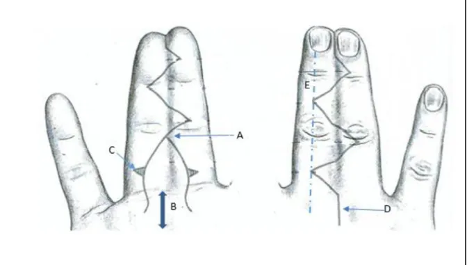 Figure 5 : Schéma et caractéristiques géométriques du lambeau palmaire de Blauth (14)