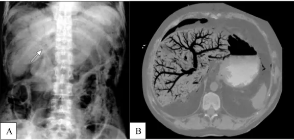 Figure 2 : Aspect radiographique et tomodensitométrique d’une aéroportie 