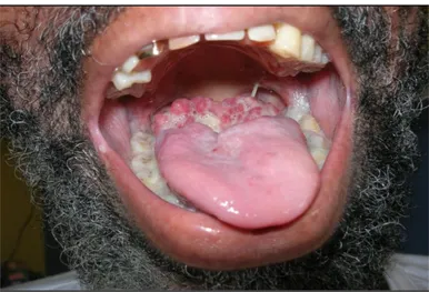 Figure 2 Ulcération bourgeonnante de la base de la langue due à Histoplasma capsulatum chez un patient de 52  ans  au  stade  SIDA