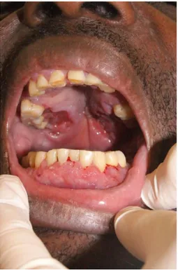 Figure 5: Ulcérations du palais mou et lésions végétantes gingivales inférieures chez un patient au stade SIDA,  atteint  d'histoplasmose  cutanéo-muqueuse