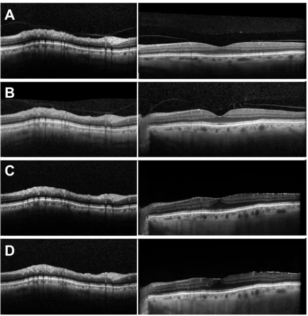 Figure 2 : SD-OCT images of the eye of an ALIENOR participant with VPA and VMA  at baseline who developed incident ERM during follow-up